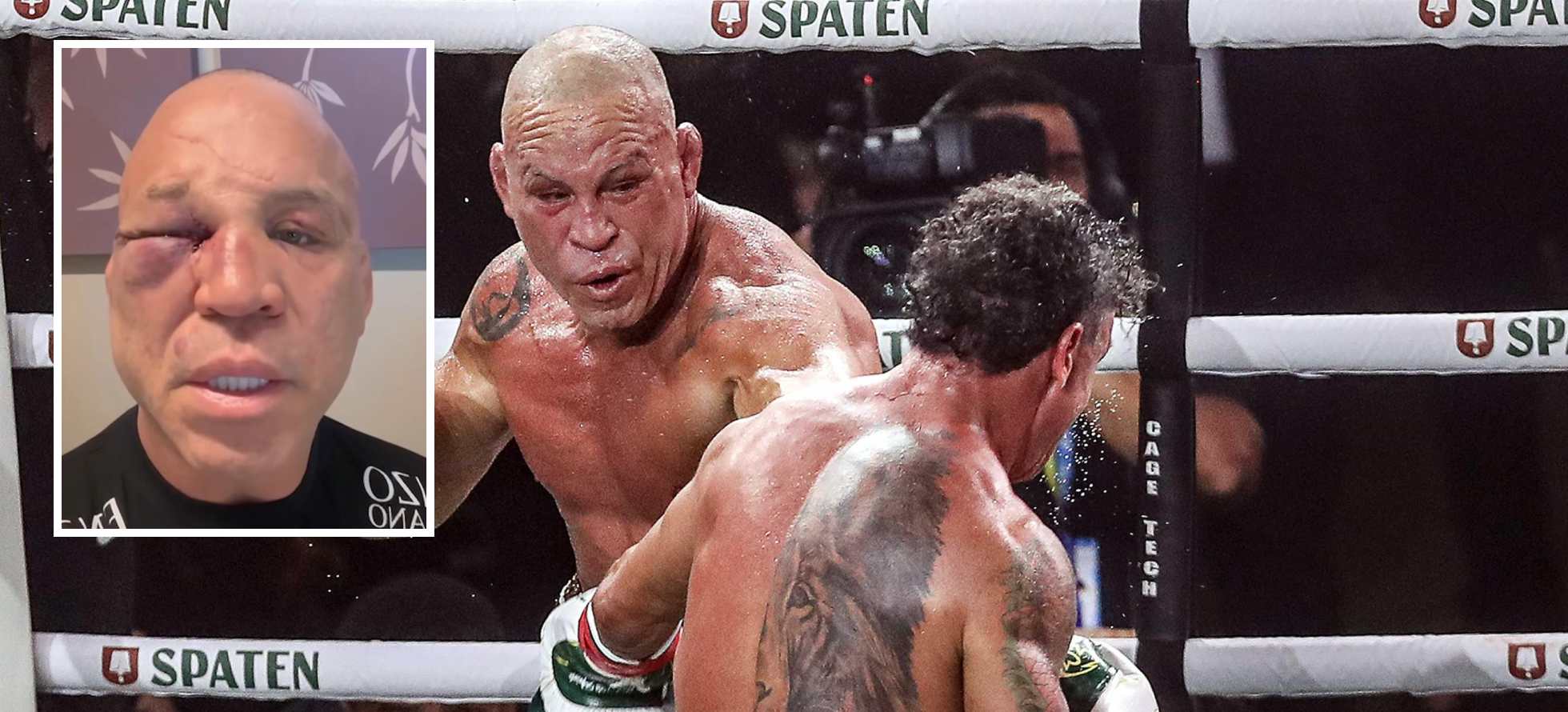 Wanderlei Silva suffered a broken nose and “serious headaches” after ...